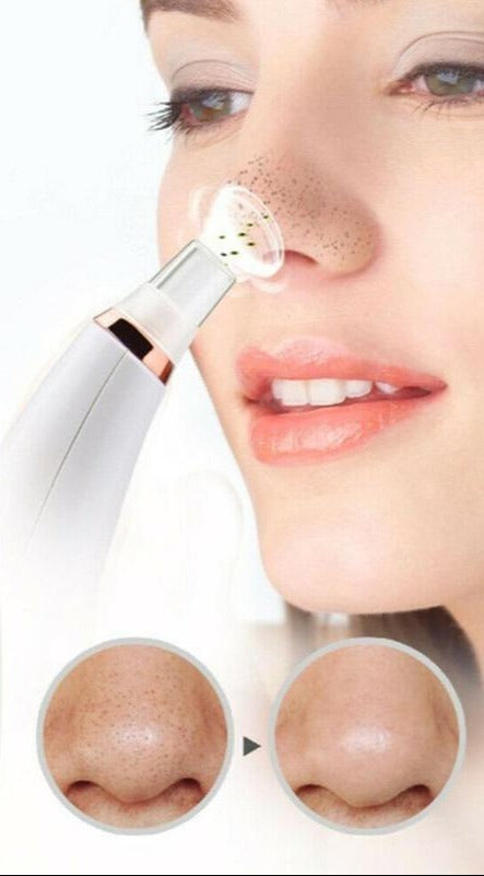 Ultimate Blackhead Vacuum - Say Goodbye to Blackheads! - Sozofy